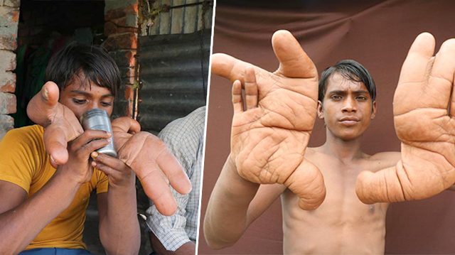 Boy with giant hands "devil hands" Tarik India
